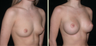 Breast Augmentation
