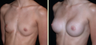 Breast Augmentation