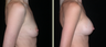 Breast Augmentation