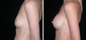 Breast Augmentation