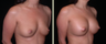 Breast Augmentation 