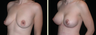 Breast Augmentation with Lift