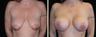 Breast Augmentation with Lift