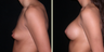 Breast Augmentation with Lift