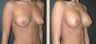 Breast Augmentation