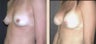 Breast Augmentation