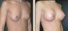 Breast Augmentation