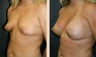 Breast Augmentation