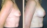 Breast Augmentation