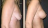 Breast Augmentation
