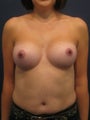 Breast Augmentation