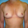 Breast Augmentation