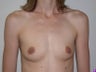 Breast Augmentation