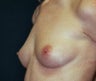 Breast Augmentation