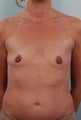 Breast Augmentation