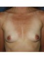 Breast Implants