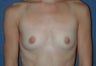 Breast Implants