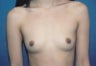 Breast Augmentation
