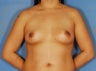 Breast Augmentation