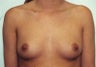 Breast Augmentation