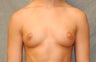 Breast Augmentation