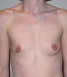 Breast Augmentation