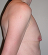 Breast Augmentation
