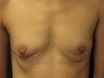 Breast Augmentation