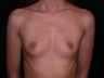 Breast Augmentation