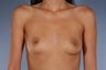 Breast Augmentation