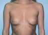 Breast Augmentation - Small B Cup to Small D Cup