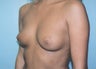 Breast Augmentation - Small B Cup to Small D Cup