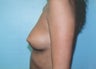 Breast Augmentation - Small B Cup to Small D Cup