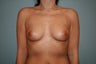 Breast Augmentation