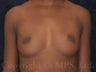 Breast Augmentation