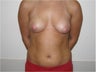 Breast augmentation