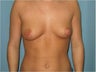 Breast augmentation