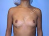 Breast Implants