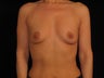 Breast Augmentation