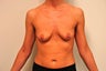 Breast Augmentation Silicone Gel Implants