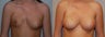 Breast Augmentation