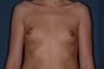 Breast Augmentation