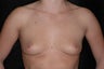 Breast Augmentation