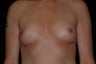 Breast Augmentation