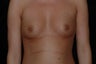 Breast Augmentation