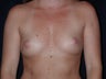 Breast Augmentation