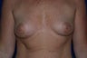Breast Augmentation