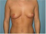 Breast Augmentation