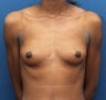 Breast Augmentation