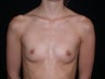 Breast Augmentation